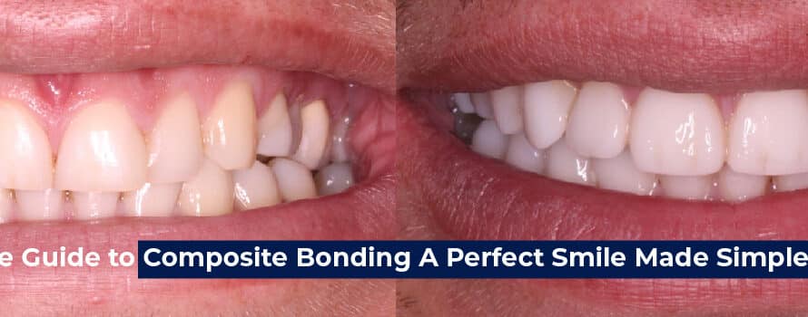 Composite Bonding