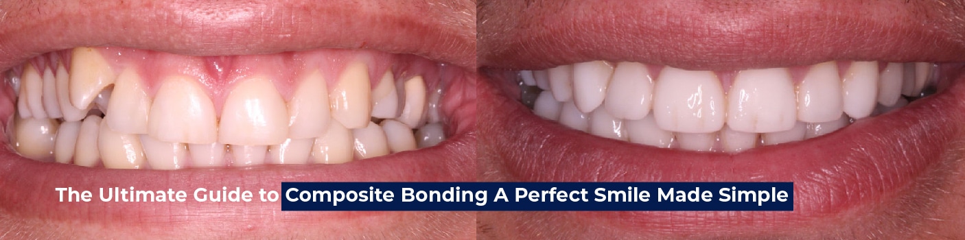 Composite Bonding